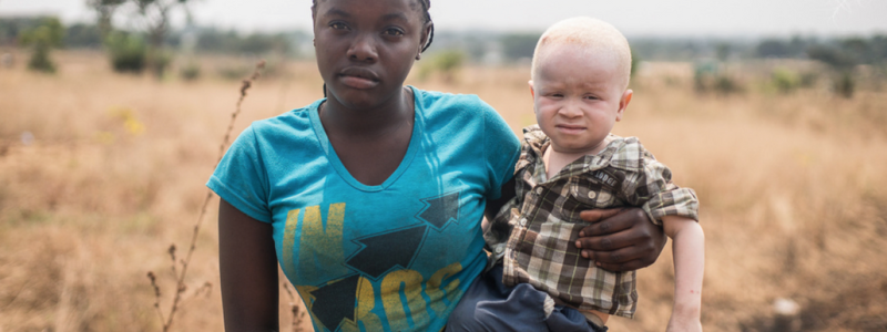 Albinism